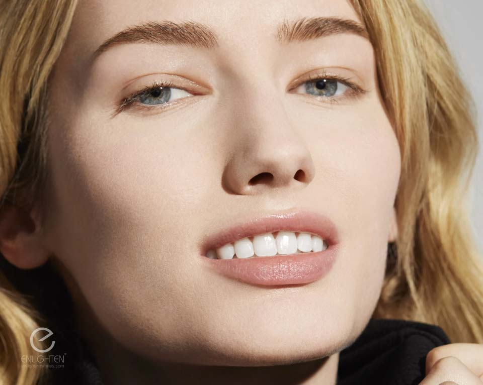 Radiant, natural VITA B1 smile achieved with Enlighten Evo4 Whitening