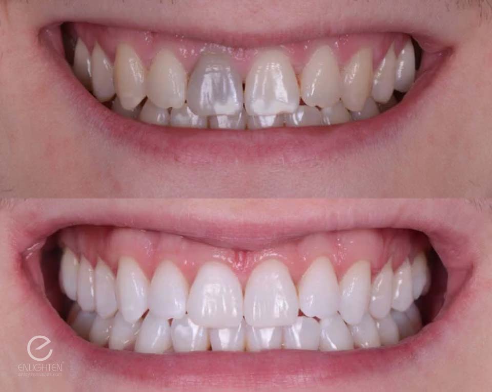 Clinical Before and After Enlighten Evolution Evo4 Teeth Whitening