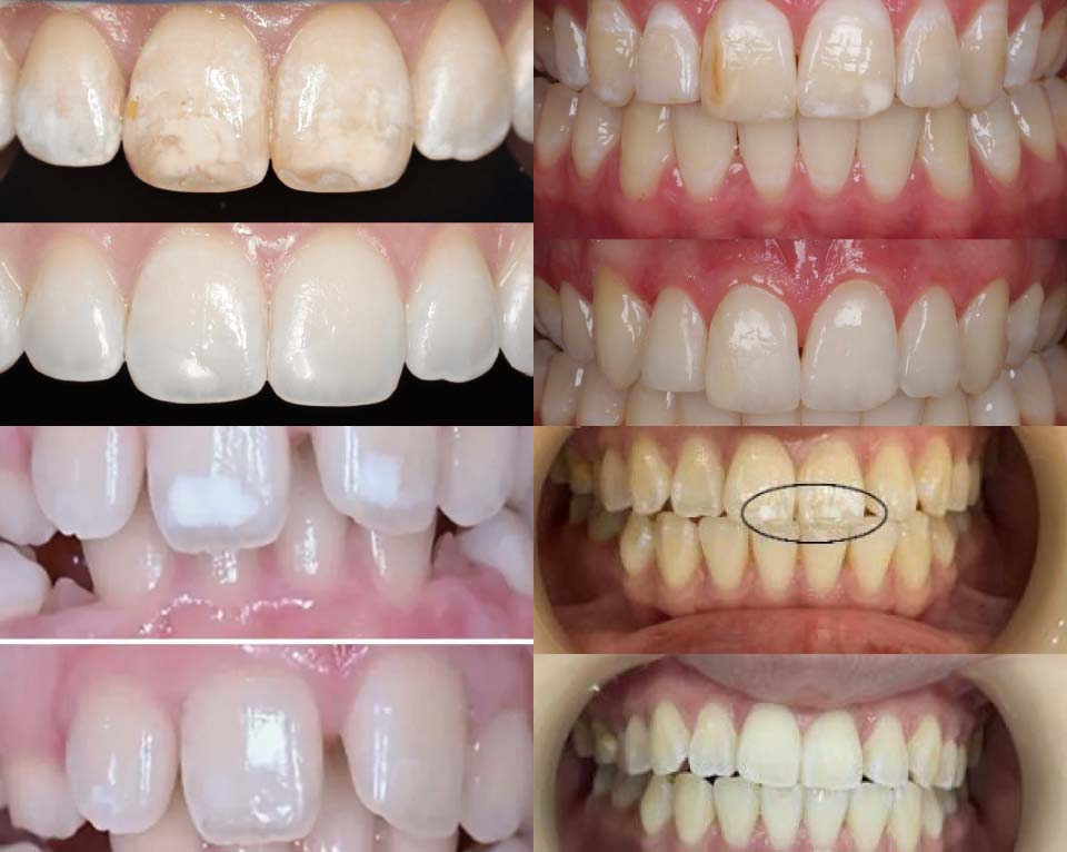 ICON Resin Infiltration clinical white spot treatment before and after